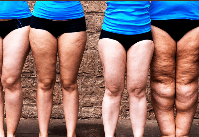 Fotobiomodulação lipedema