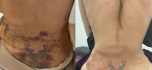 Dermalux Cicatrização pós operatória fotobiomodulação